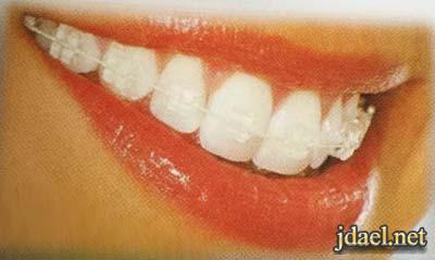 العناية الصحية بعد تركيب تقويم الاسنان في البيت نصائح طبية